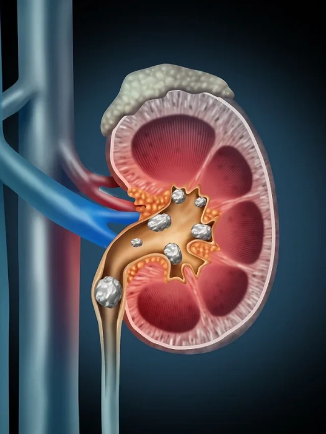 Kidney Stone:7 Reasons you should know,kidney stone treatment